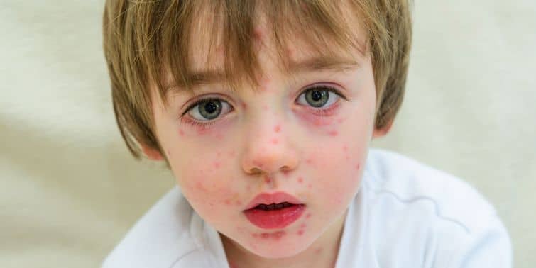 Chickenpox Manifestations, Causes, Risk Factors, Treatment And Don't Worry!
