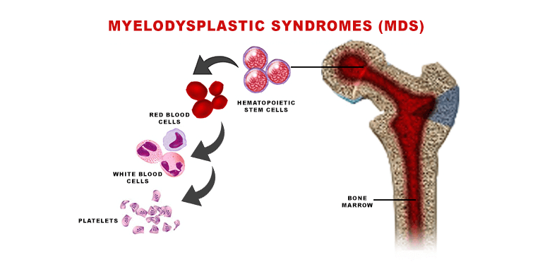 Myelodysplastic Syndromes (MDS) Causes, Symptoms, Diagnosis, Types And Treatments