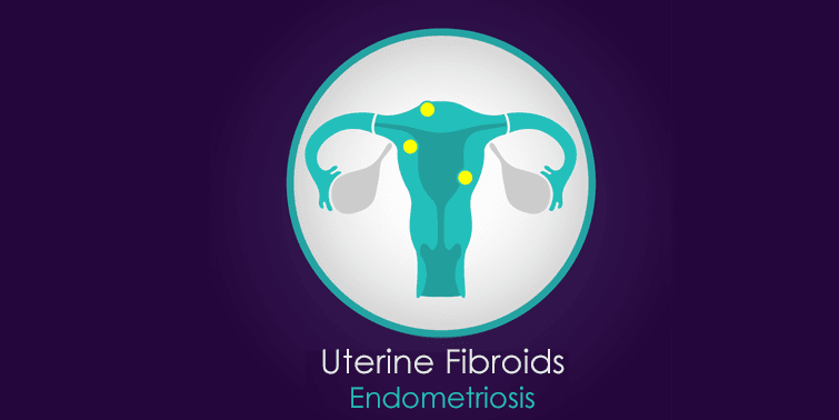 Endometriosis Or Uterine Fibroids Indications, Symptoms, Causes And Treatment