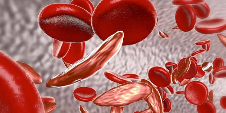 Sickle Cell Anemia (SCA) Causes, Symptoms And Treatment