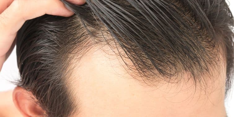 Androgenic Alopecia Or Male Pattern Baldness Symptoms, Causes and Treatment